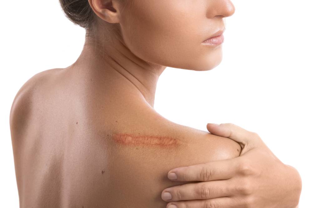 Scar Removal Treatments in Arlington Heights
