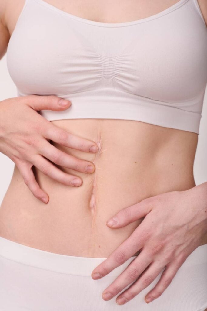Scars Treatment Kendall Illinois